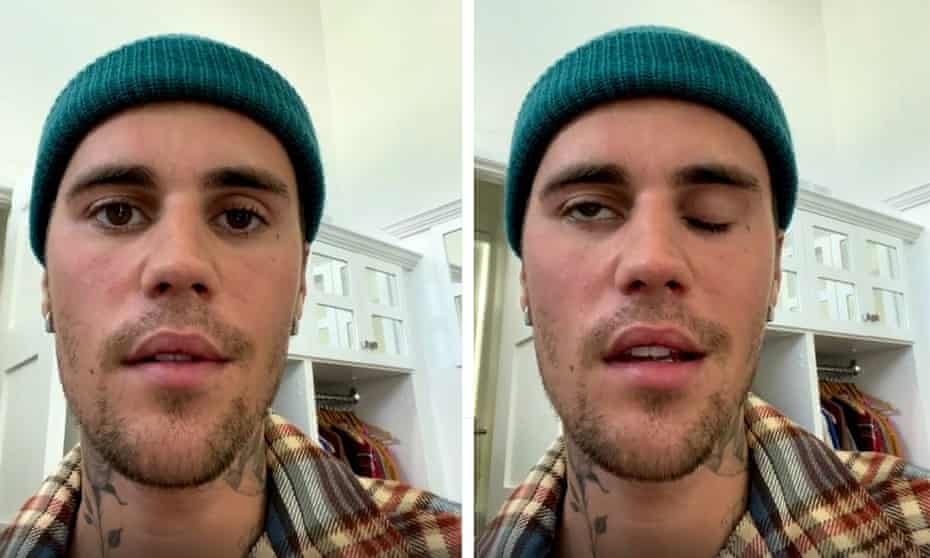 Justin Bieber's face paralysis